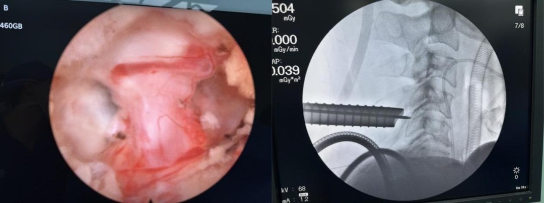 立竿见影！“钥匙孔”微创术解决颈椎病