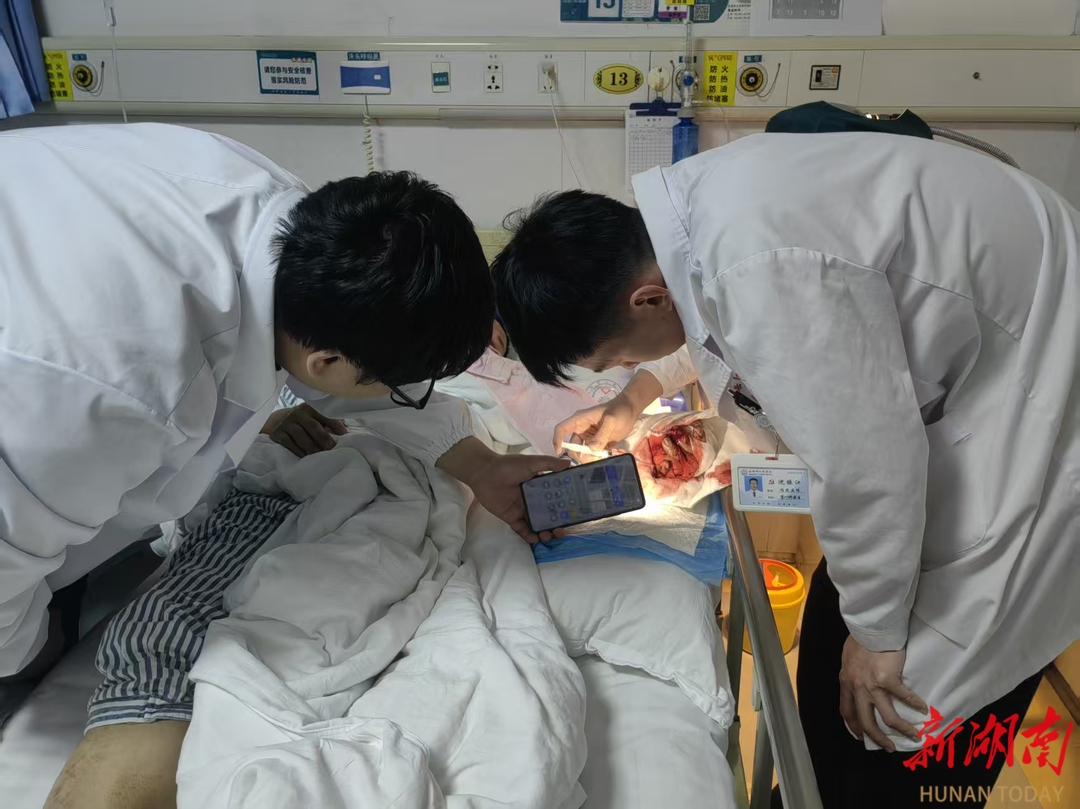 岳阳帅哥心灵手巧 完成首例断指再植